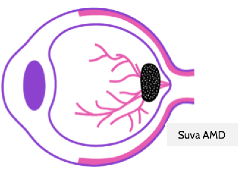 prikaz nezdravog oko